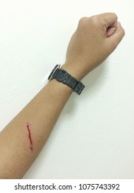 Fresh Wound And Blood From A Bite Cat. It Is Still Possible To Get Rabies From A Cat Scratch.