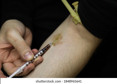 Front and close view of the hematoma arm of a cocaine addict man, while injecting cocaine into his arm with a syringe, and a tourniquet tied to his arm