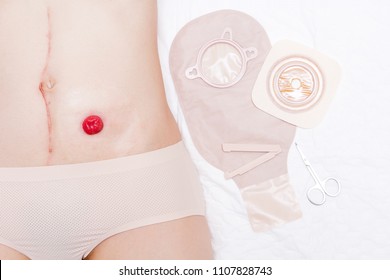 Front view closeup stoma and colostomy with long abdominal surgical scar, after colon cancer surgery with 2 pieces colostomy bag.Landscape.
