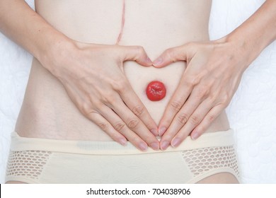 Front view closeup stoma and colostomy with long abdominal surgical scar, after colon cancer surgery.Landscape.Heart shape hands frame.