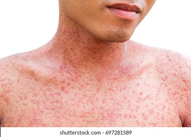 Front View Of A Man With A Problem Skin Rash