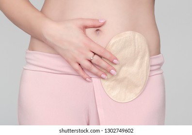 front view on colostomy bag attached to woman patient, medical theme. Skin color ostomy pouch close-up. Colon cancer surgery treatment. 