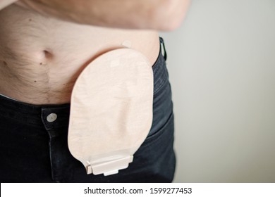 Front view on colostomy bag attached to man patient, medical theme. Selective focus on skin color ostomy pouch close-up. Colon cancer surgery treatment. Copy space.