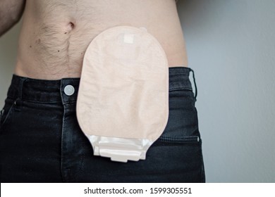 Front view on colostomy bag attached to man patient, medical theme. Skin color ostomy pouch close-up. Colon cancer surgery treatment. 