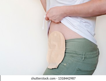 Front view on colostomy pouch in skin color attached to young woman patient. Close-up on ostomy bag after surgery. Medical theme. Space for text. Negative space.