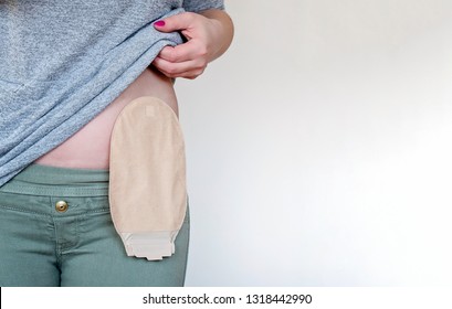 Front view on colostomy pouch in skin color attached to young woman patient. Close-up on ostomy bag after surgery. Medical theme.