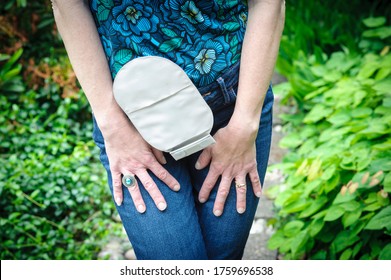 Front view on colostomy pouch in skin color attached to woman patient. Close-up on ostomy bag after surgery. Medical theme.