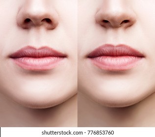 Front view on female nose before and after surgery.