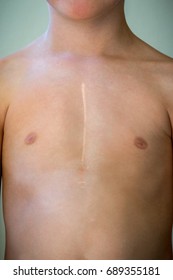 Front View Of Young Caucasian Boy With Healed Surgical Scar After Heart Surgery.