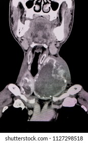 Frontal or anterior view CT scan showing extremely enlarged thyroid gland on both sides of neck in an elderly woman Asian patient comes with history of chronic breathing difficulty