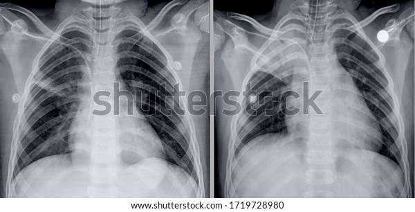 Frontal Chest Xray Right Apical Atelectasis Stock Photo 1719728980 ...