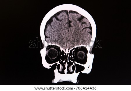 frontal coronal plane ct scan head stock photo edit now 708414436