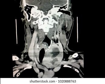 Frontal Cut Or Anterior Plain Of CT Scan Showing Extremely Enlarged Thyroid Gland Causing Upper Airway Obstruction In A Young Asian Female Patient Comes With History Of Chronic Breathing Difficulty