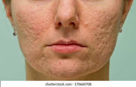 Frontal View Of Girl's Cheeks And Chin With Acne Scars