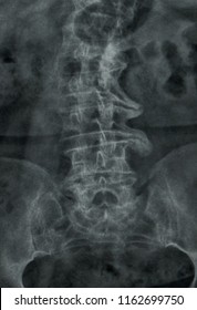 Frontal View Lumbar Spine X-Ray. Parrot's beaks. Arthrosis. Degenerative rheumatological disease. Joint's pain.