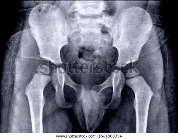 Frontal x-ray bones of a\
child\'s pelvis