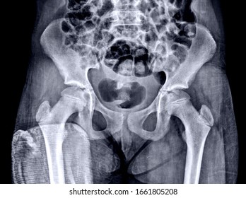 Frontal X-ray Of The Thigh Without Hip Compromise