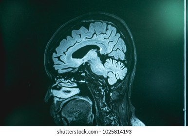 Frontotemporal Dementia With MRI