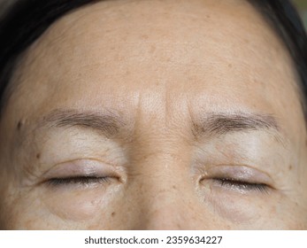 Frown lines, sometimes called worry lines, are the vertical lines that appear between your eyebrows. They are the result of your forehead muscles squeezing inward as you furrow your brows.