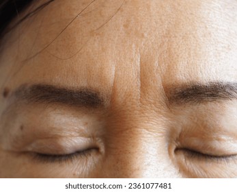 Frown lines, sometimes called worry lines, are the vertical lines that appear between your eyebrows. They are the result of your forehead muscles squeezing inward as you furrow your brows. - Shutterstock ID 2361077481