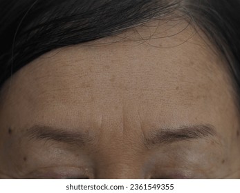 Frown lines, sometimes called worry lines, are the vertical lines that appear between your eyebrows. They are the result of your forehead muscles squeezing inward as you furrow your brows. - Shutterstock ID 2361549355