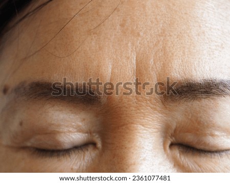 Frown lines, sometimes called worry lines, are the vertical lines that appear between your eyebrows. They are the result of your forehead muscles squeezing inward as you furrow your brows.