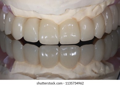 A Full Arch Dental Implant Bridge With Mirror Reflection