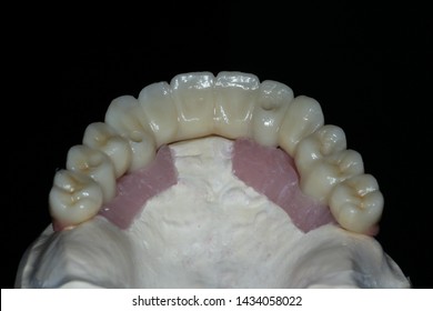 A Full Arch Full Zirconia Dental Implant Supported Bridge On A Stone Model