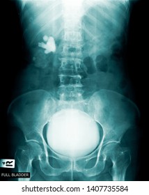 full bladder x-ray image  in blue tone
