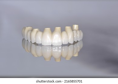 Full Ceramic Dental Arch On 8 Implants