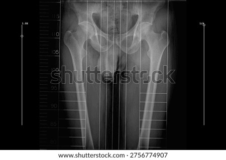 full length standing scanogram of the bilateral lower limbs, captured from the pelvis to the ankle with integrated rulers to assist in orthopedic analysis for limb length measurement and alignment