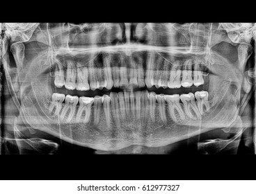 Full mouth dental x-ray. Black and white