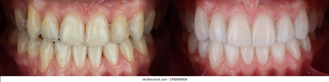 Full Mouth Pressed Ceramic Veneer For Smile Makeover, Result In Whiter And Well Aligned Teeth.