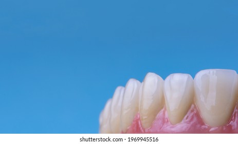 Full Mouth Rehabilitation With Zirconia Bridge On Implants