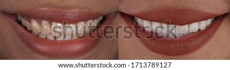 Full mouth smile makeover with dental ceramic veneers treatment, present of clean, perfect, youth and white teeth smile. Before and after close up smile.