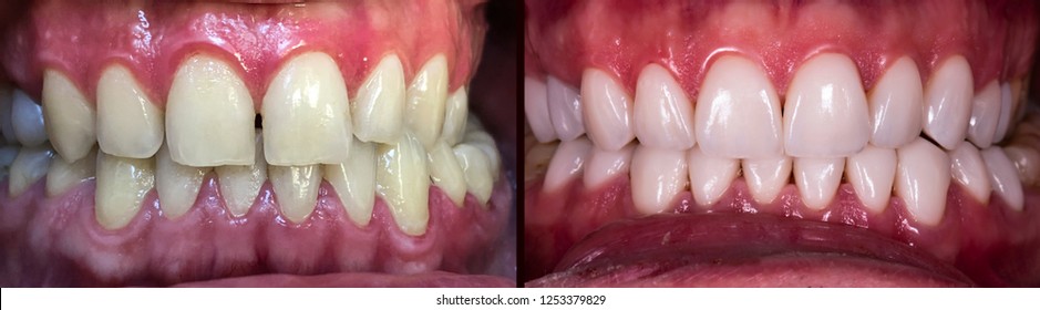 Full Mouth Veneers 