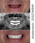 Full-arch dental prosthesis with the All on Four and All on X treatment concept for edentulous jaws in dental implant treatment. Dental X ray image and dental before and after smile design.