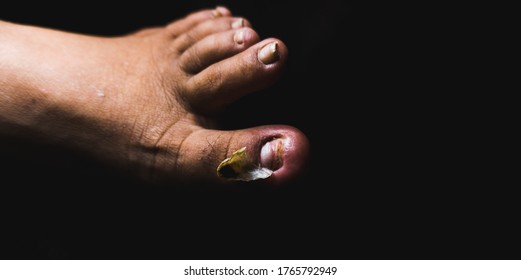 fully-broken-leg-thumb-nail-stock-photo-1765792949-shutterstock