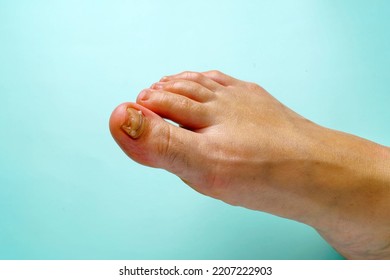 Fungal Disease Damaged Foot Nail Corrected With Titanium Thread