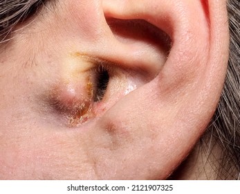 Fungal Ear Infection, Close Up