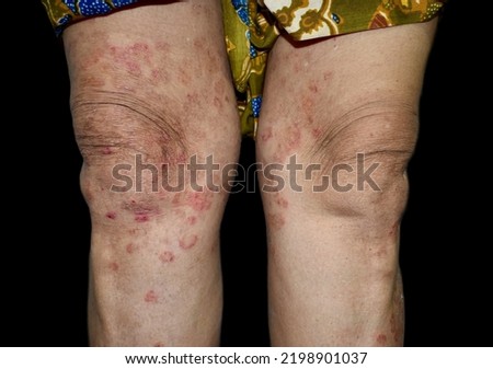 Fungal infection called tinea corporis in leg of Asian woman. Widespread ringworm over lower limb.