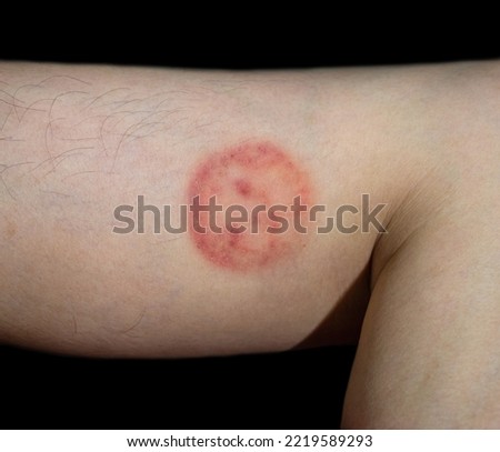 Fungal infection called tinea corporis in Southeast Asian man. Ringworm