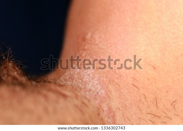 Fungal Infection Groin Psoriasis Dermatitis Eczema Foto Stok 1336302743 Shutterstock 