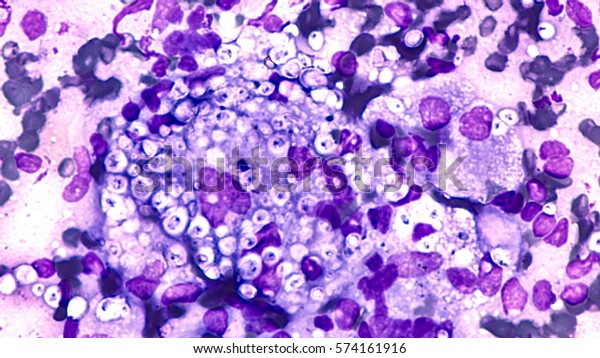 https://image.shutterstock.com/image-photo/fungal-infection-lung-histoplasmosis-fine-600w-574161916.jpg
