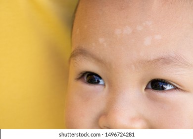 Fungal Infection On Face Of Child , It Is A Superficial Dermatophyte Infection Limited To The Glabrous Skin Of The Face, A Common Skin Condition Mostly Occurring In Children.Health Care Concept.