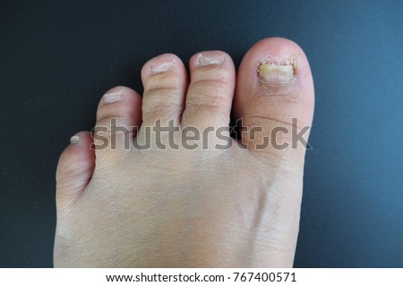 Fungal nail infection, Detmatophytic onychomycosis, Tinea unguium ,a half yellow of infected thumbnail on foot ,disease from rainy or unhealthy feet in black background