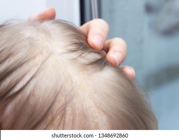Seborrhea Images Stock Photos Vectors Shutterstock