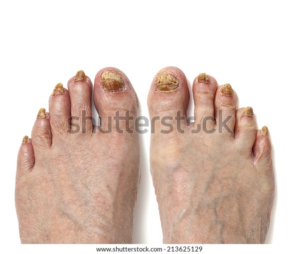 infeccion fungica en las uñas