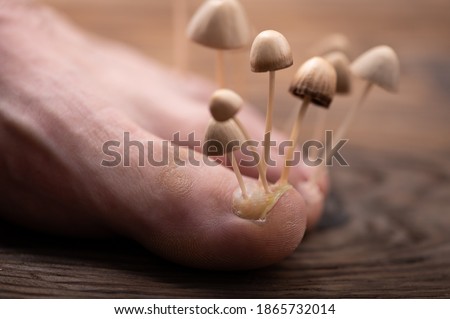 Fungi grow from the nail plates on the foot. Concept of nail fungus, skin and nail infections. Foot with fungus close-up in the background light.