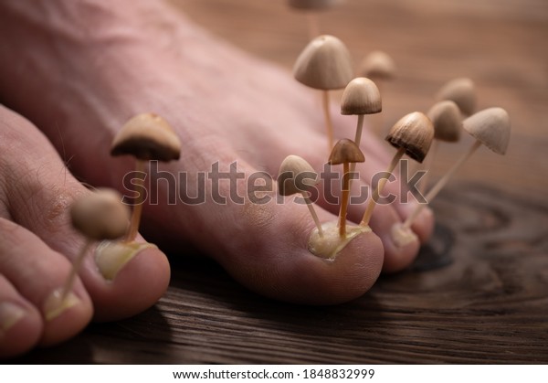 Fungi grow from the nail plates on the\
feet. Concept of nail fungus, skin and nail infections. Two legs\
with a fungus close-up in the background\
light.